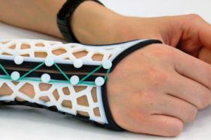 3-D Printed Wrist Splints for Arthritis
