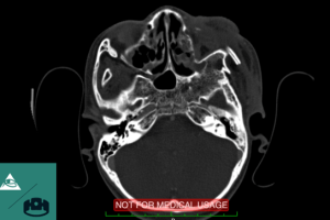 OsiriX Connector: Myo-controlled Radiology Software